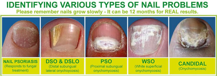 Nail Psoriasis: Symptoms, Treatments and More - YouTube
