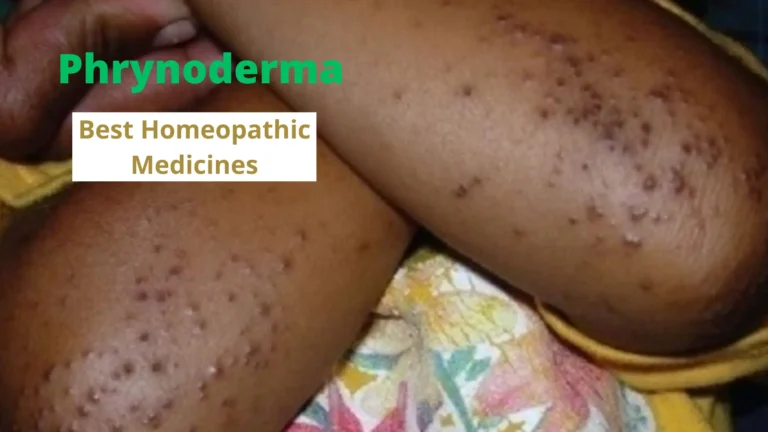 Phrynoderma- Symptoms, Causes and Best Homoeopathic Treatment