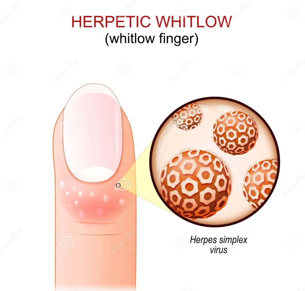PDF) Atypical presentation of herpetic whitlow as dark brown vesicles in a  hyperbilirubinemic patient