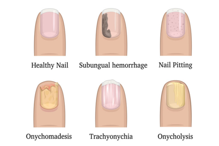 Why White Spots Appear On Nails - Health - Nigeria