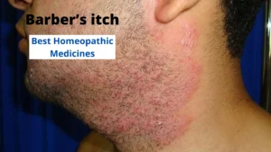 Barber’s itch and its Best Homoeopathic Treatment