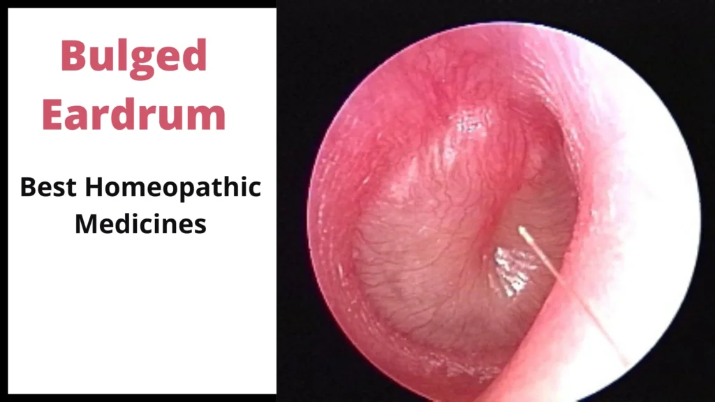 Bulged Eardrum - Symptoms and Best Homoeopathic Medicines