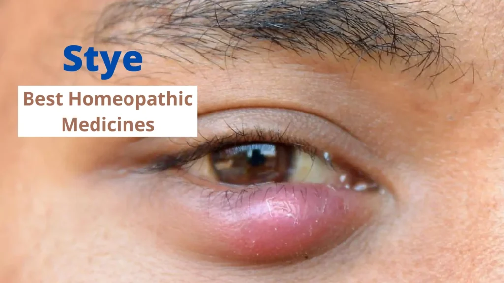 Homeopathy For Stye - Causes, Symptoms and Best Medicines