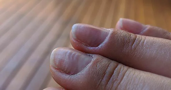 Nail fungal infection: Causes, treatment, and symptoms