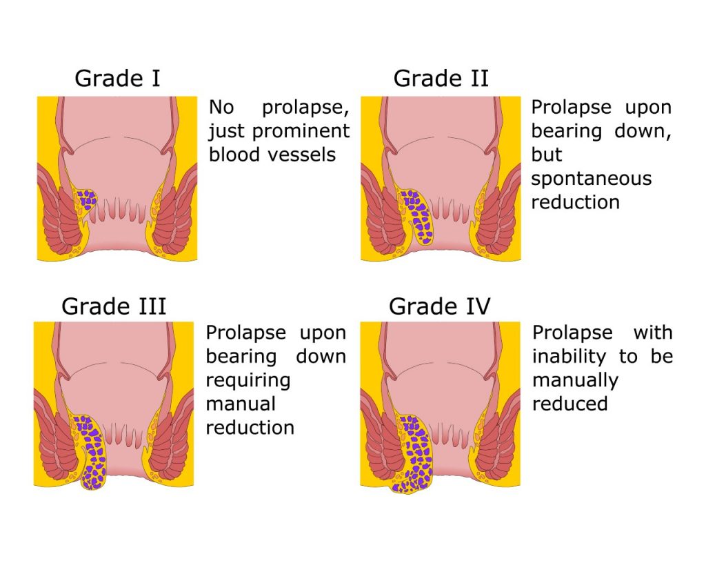 Best Homeopathic Remedy For Hemorrhoids Causes Cure   Haemorrhoid Classified 4 Grades 1024x816 1 