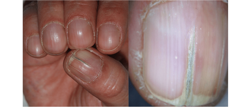 Nail Pitting: Causes and Treatment Ways | HealthNews