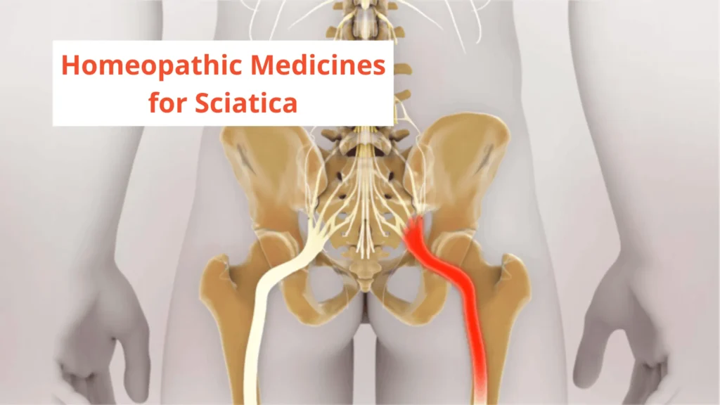 10-best-homeopathic-medicine-for-sciatica