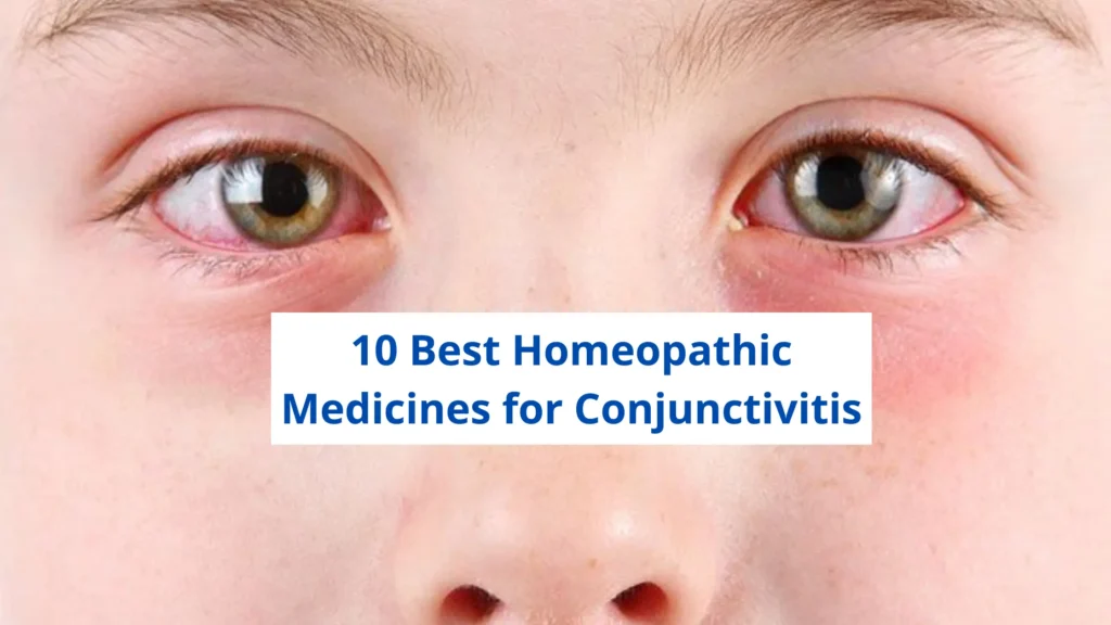 10 Best Homeopathic Medicine For Conjunctivitis