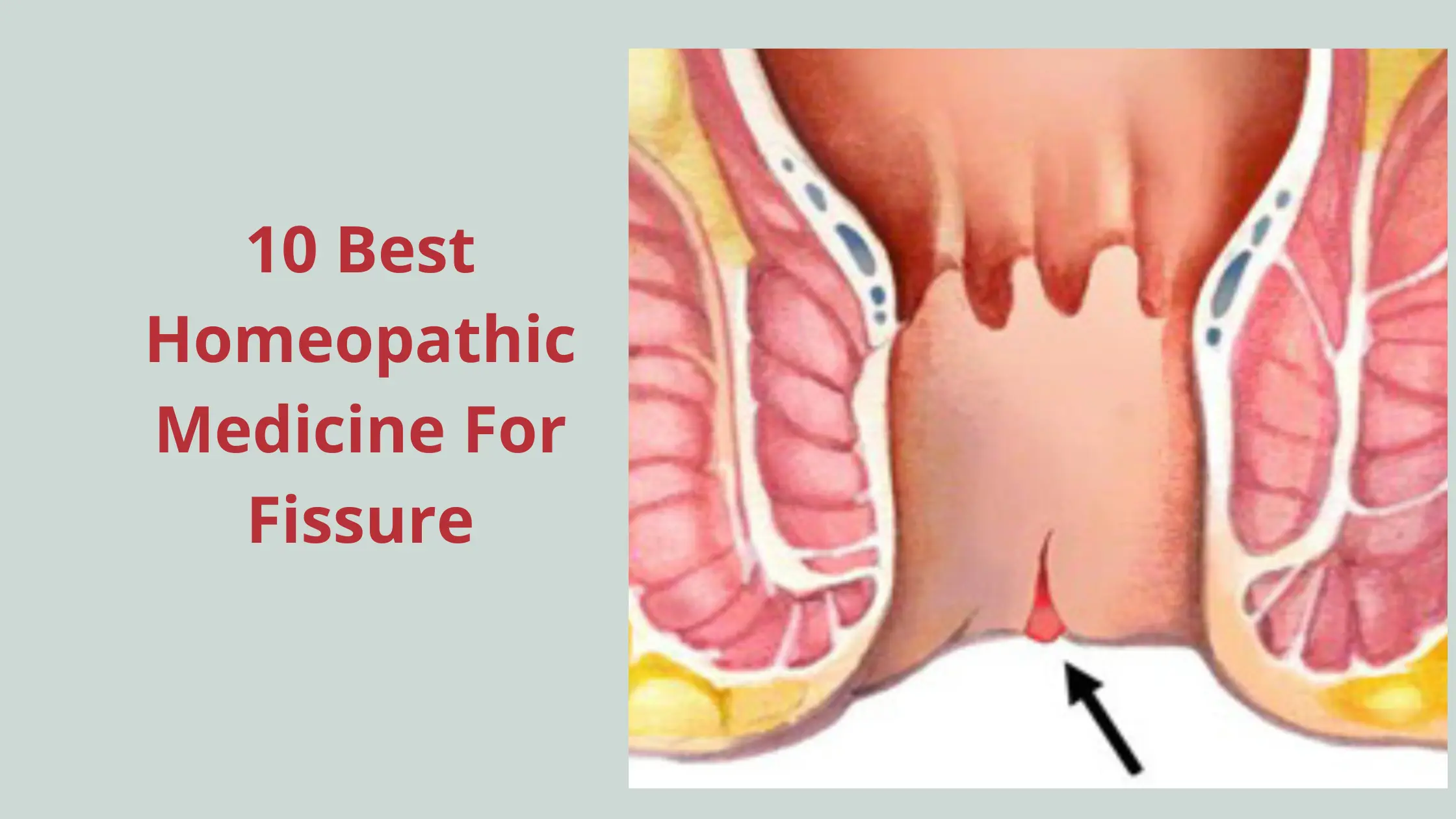 10 Best Homeopathic Medicine For Fissure