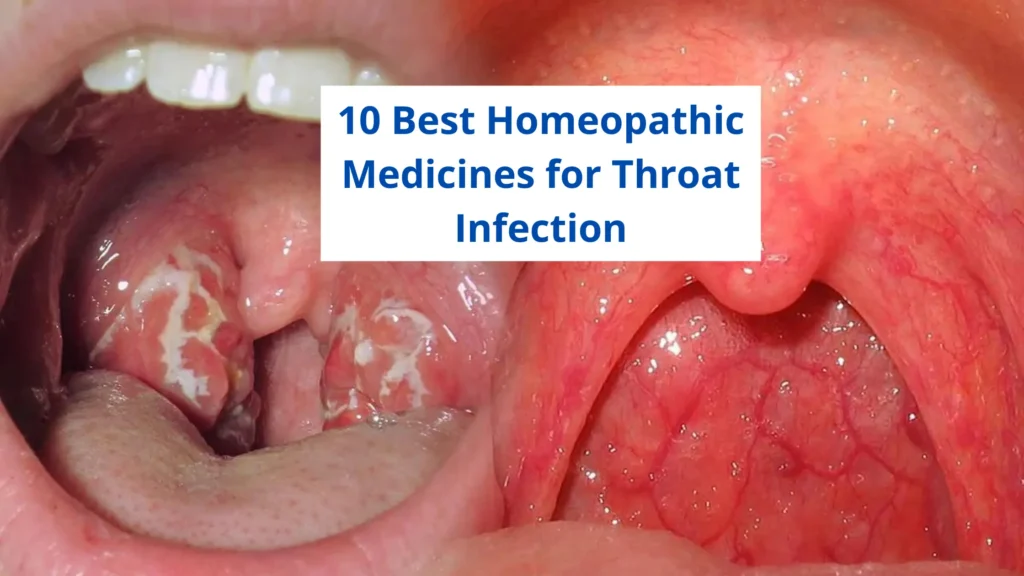 10-best-homeopathic-medicine-for-throat-infection