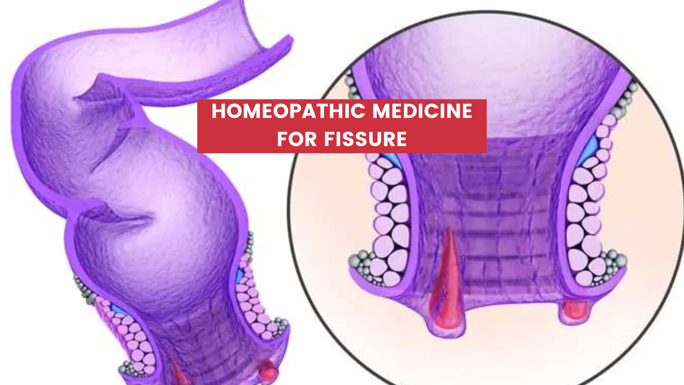 Homeopathic Medicine For Fissure