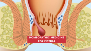 Top 10 Homeopathic Medicine for Fistula