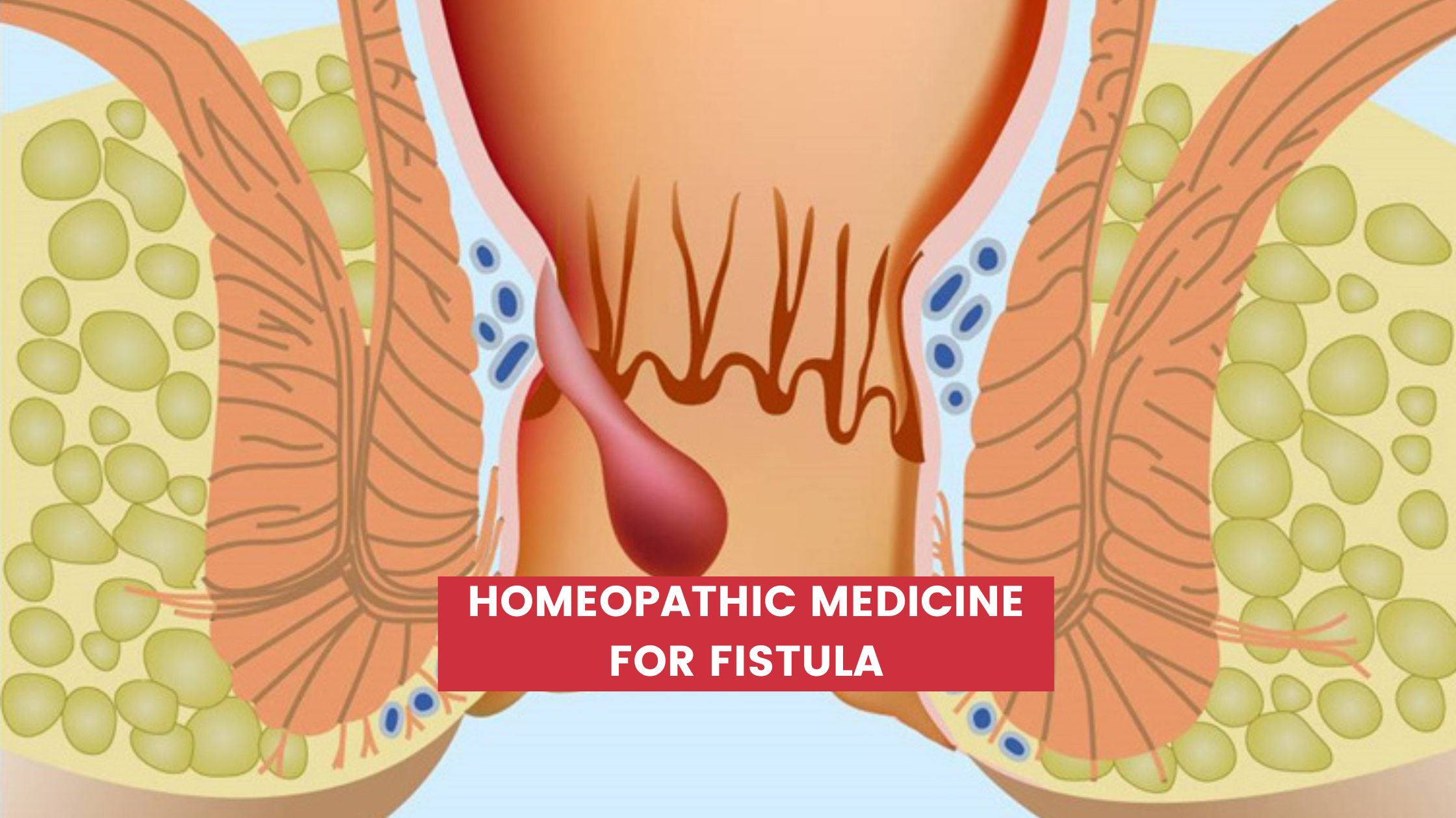 Homeopathic Medicine for Fistula