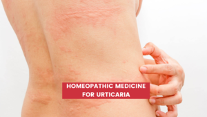 Homeopathic Medicine for Urticaria