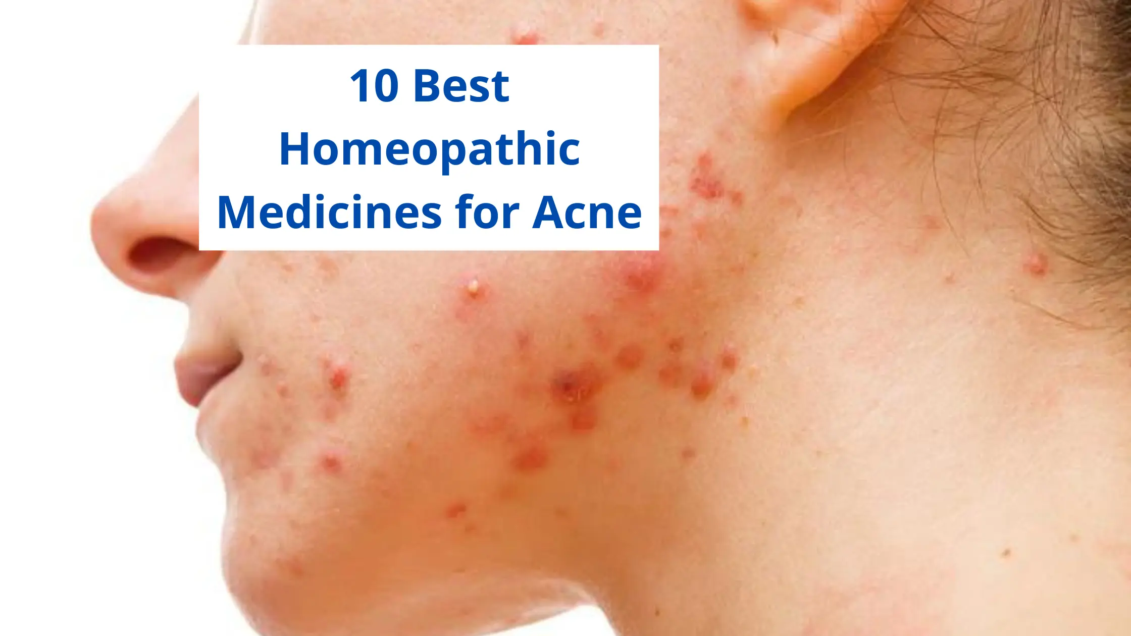 10 Best Homeopathic Medicine For Acne