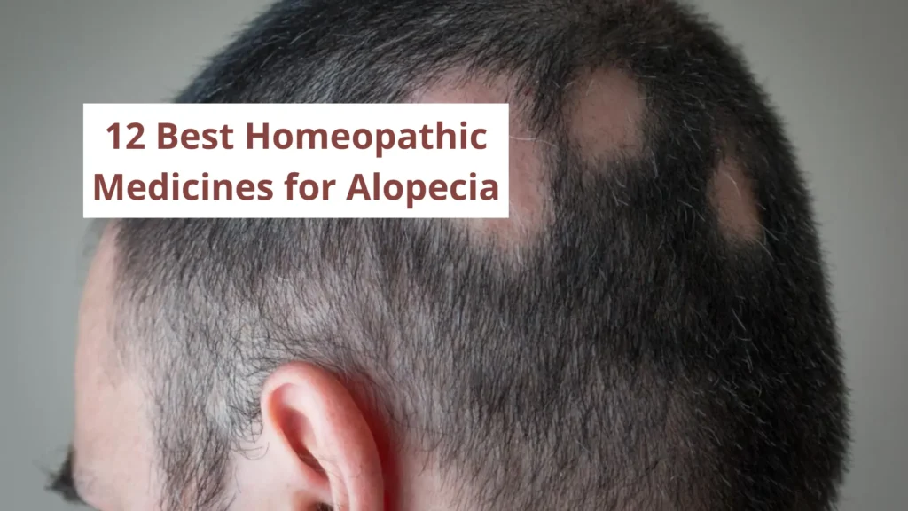10 Best Homeopathic Medicine for Alopecia Areata