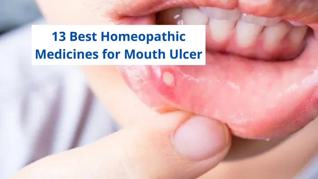 13 Best Homeopathic Medicine For Mouth Ulcer
