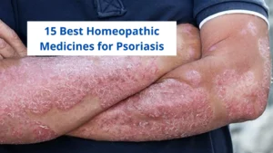 15 Best Homeopathic Medicine For Psoriasis