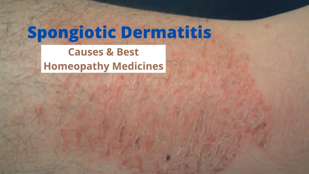 Spongiotic Dermatitis Causes, Symptoms & Treatment