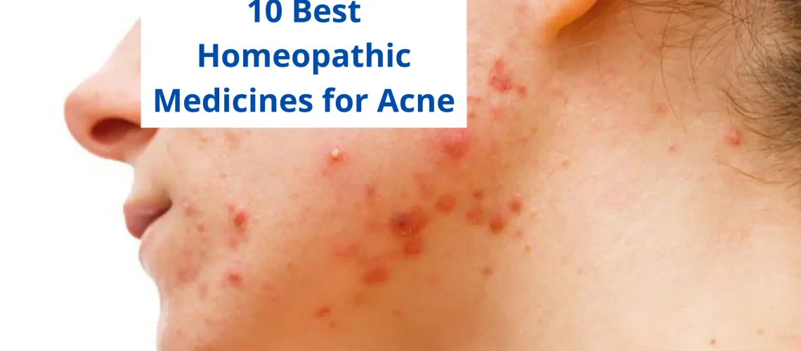 10 Best Homeopathic Medicine For Acne