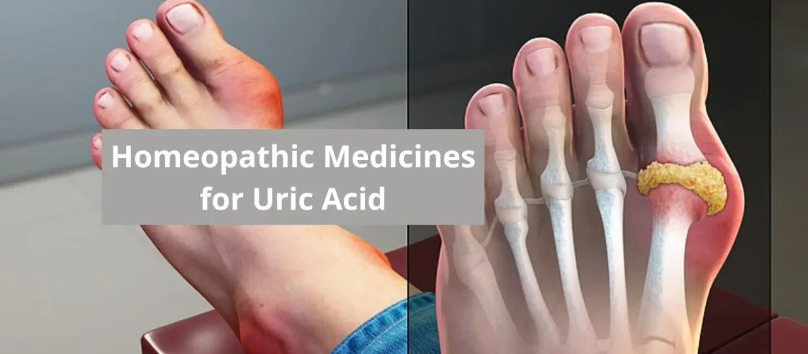 10 Best Homeopathic Medicine For Uric Acid