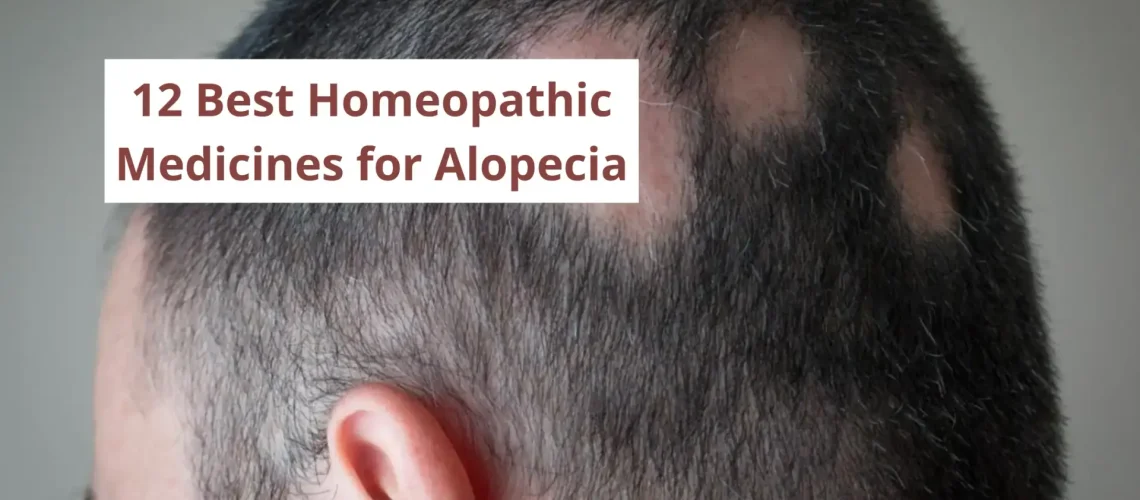 10 Best Homeopathic Medicine for Alopecia Areata