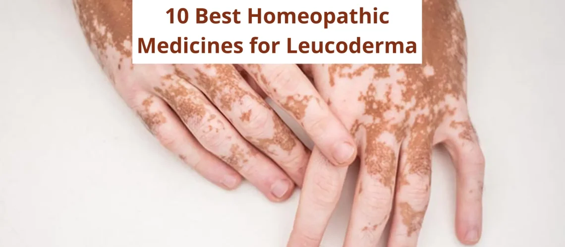 10 Best Homeopathic Medicine for Leucoderma