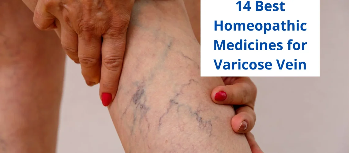 14 Best Homeopathic Medicine For Varicose Veins