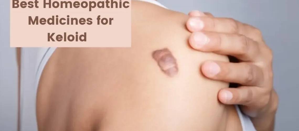 15 Best Homeopathic Keloid Medicine - Removal and Treatment
