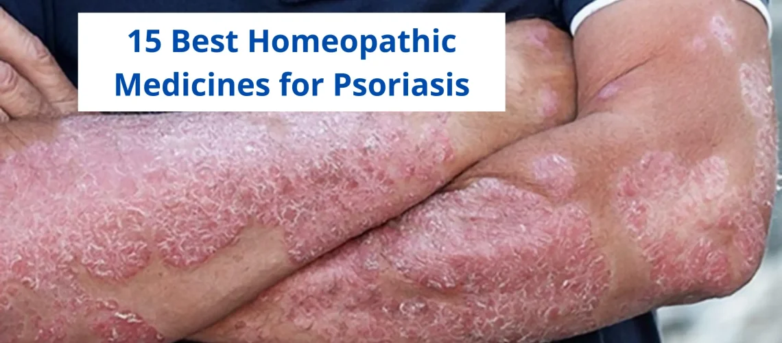 15 Best Homeopathic Medicine For Psoriasis