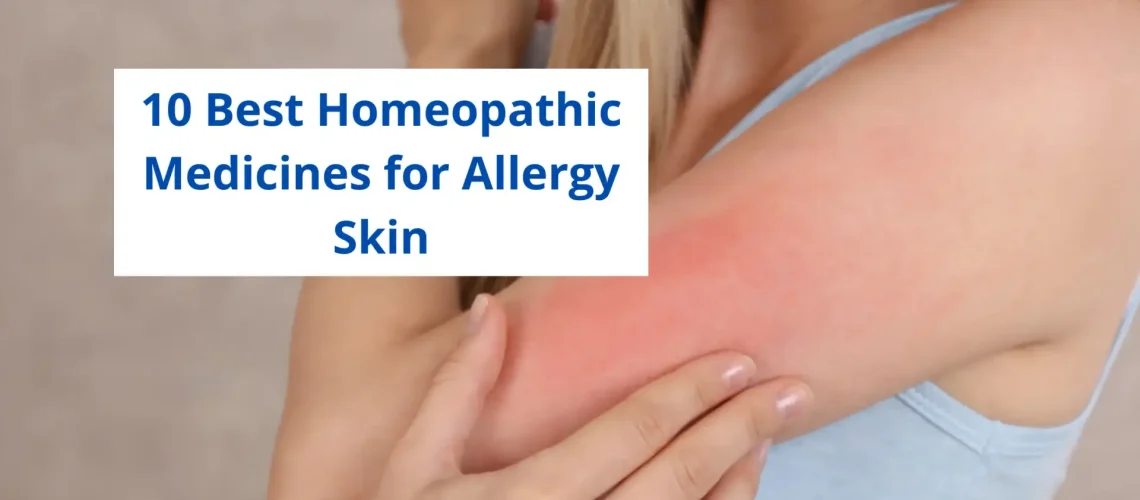 15 Best Homeopathic Medicine for Allergy Skin