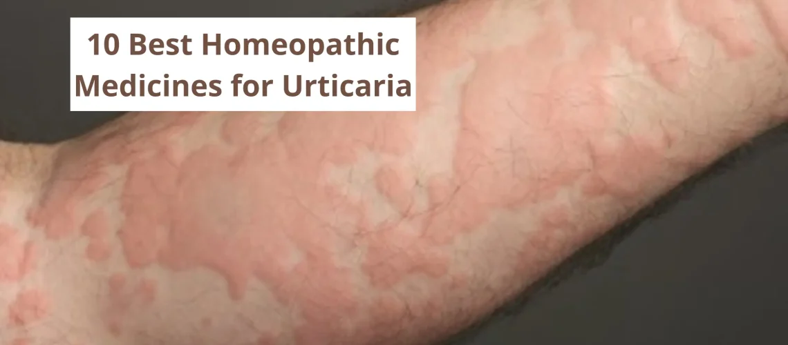 15 Best Homeopathic Medicine for Urticaria