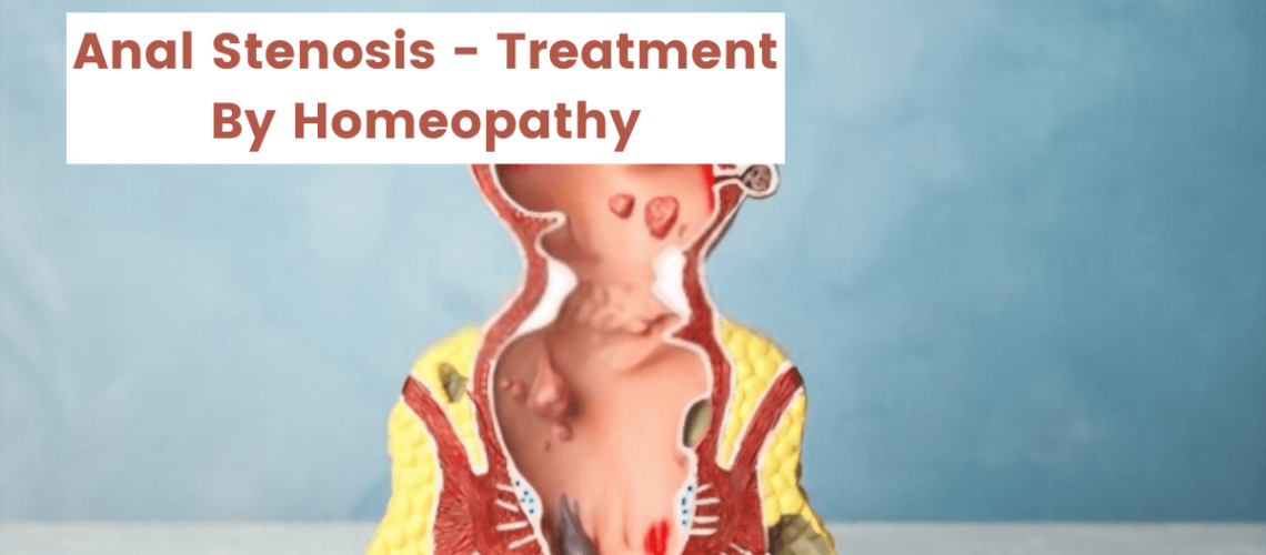 Anal Stenosis - Symptoms, Causes and 10 Homeopathic Medicines