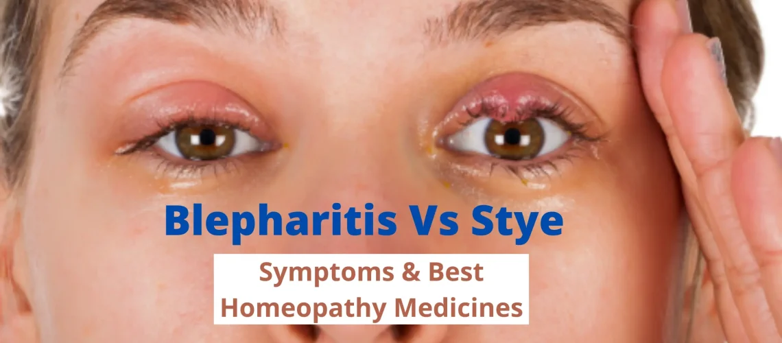 Blepharitis Vs Stye - Symptoms and Best Homeopathic Medicines