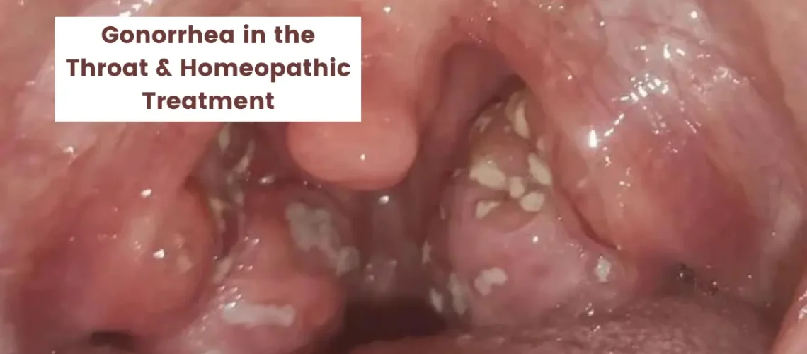 Gonorrhea in the Throat and its Best Homeopathic Treatment