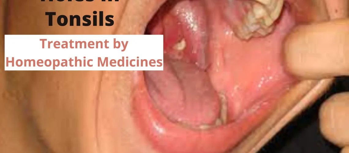 Holes In Tonsils – Symptoms, Causes and Homeopathy Treatment