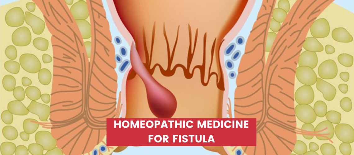 Homeopathic Medicine for Fistula