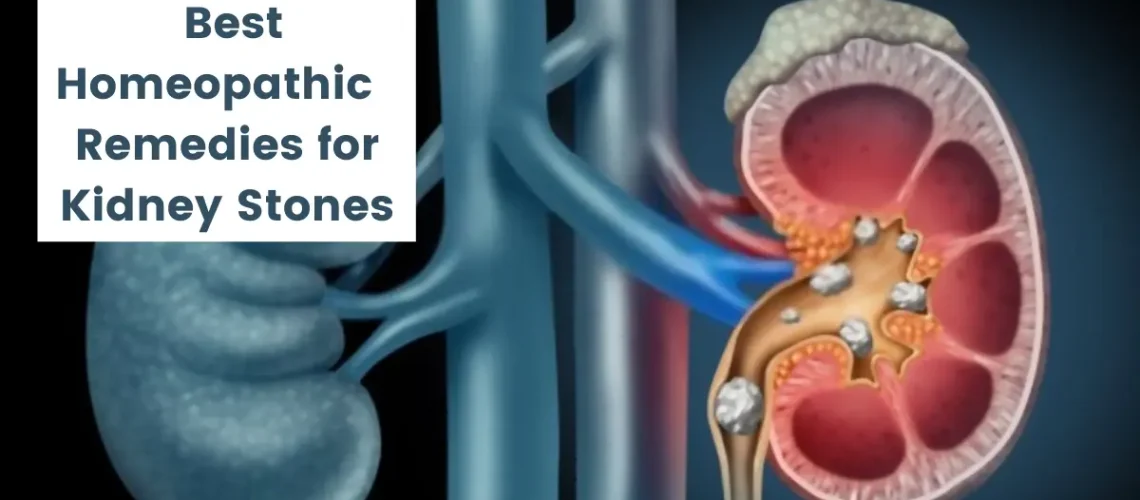 Homeopathic Remedies for Kidney Stone - Causes and Cure