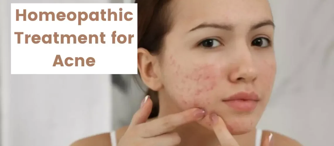 Homeopathy For Acne- Causes, Symptoms and Treatments