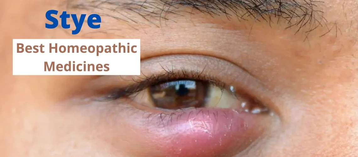 Homeopathy For Stye - Causes, Symptoms and Best Medicines