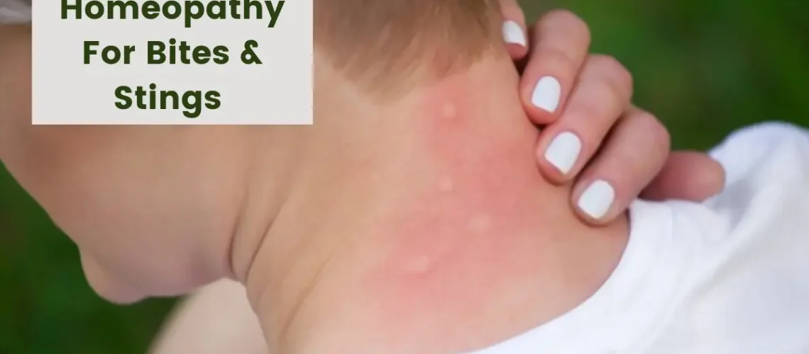 Homeopathy for Bites and Stings - Best 10 Medicines