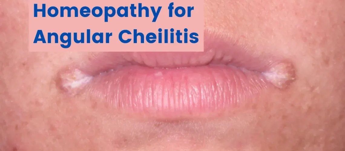 Homeopathy for Cracks In Corner Of Mouth (Angular Cheilitis)