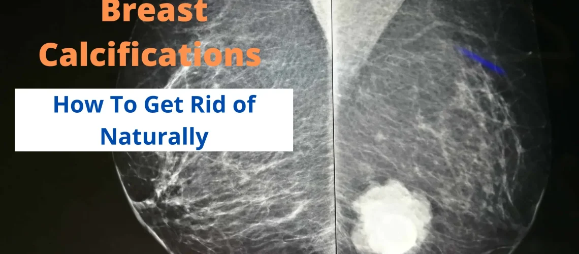 How To Get Rid of Breast Calcifications Naturally