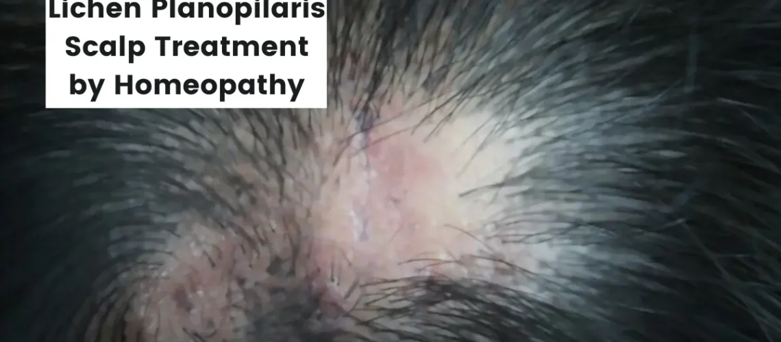 Lichen Planopilaris Scalp Treatment by Homeopathy