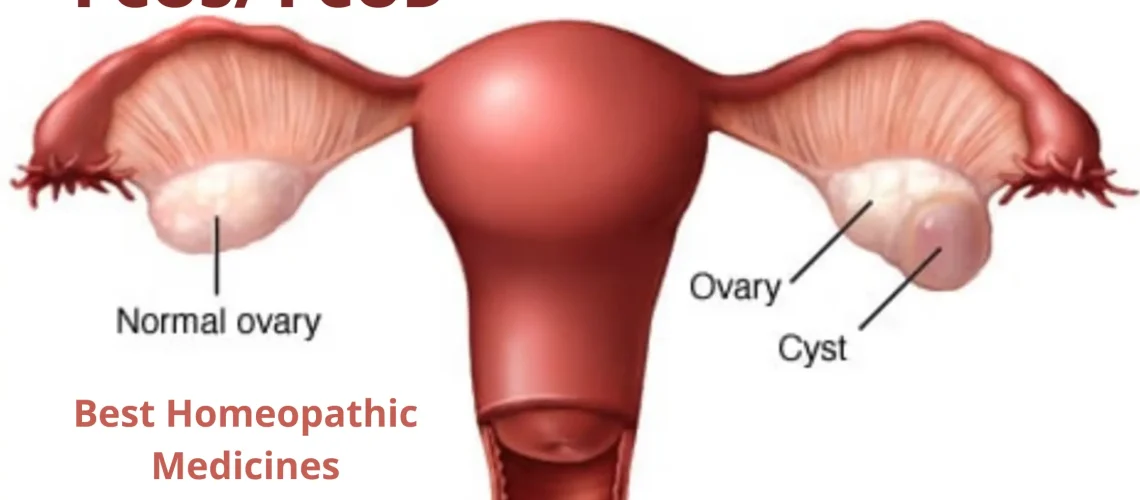 PCOS PCOD - Causes, Symptoms and Homeopathy Treatment