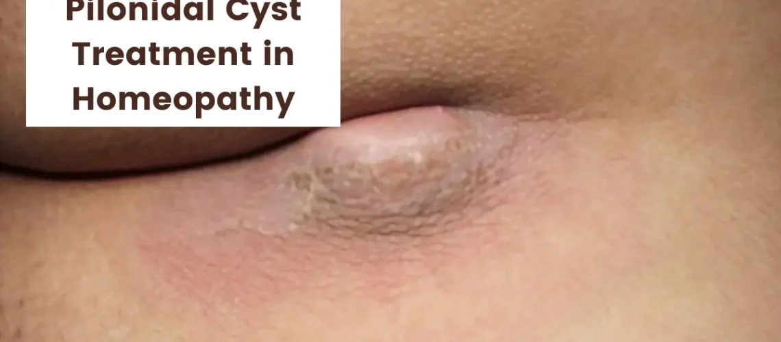 Pilonidal Cyst - Causes, Symptoms and Treatment in Homeopathy