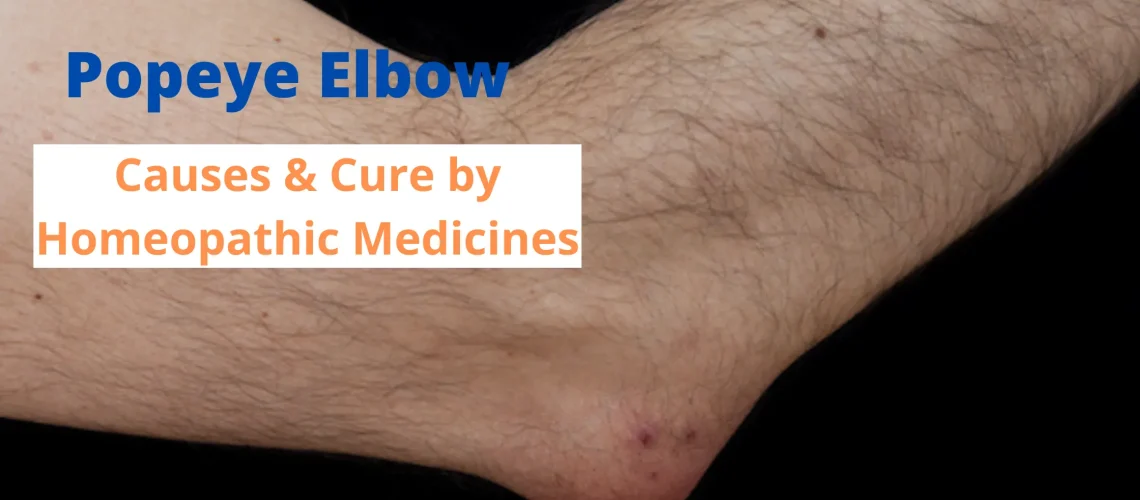 Popeye Elbow Effective hoemopathic medicines