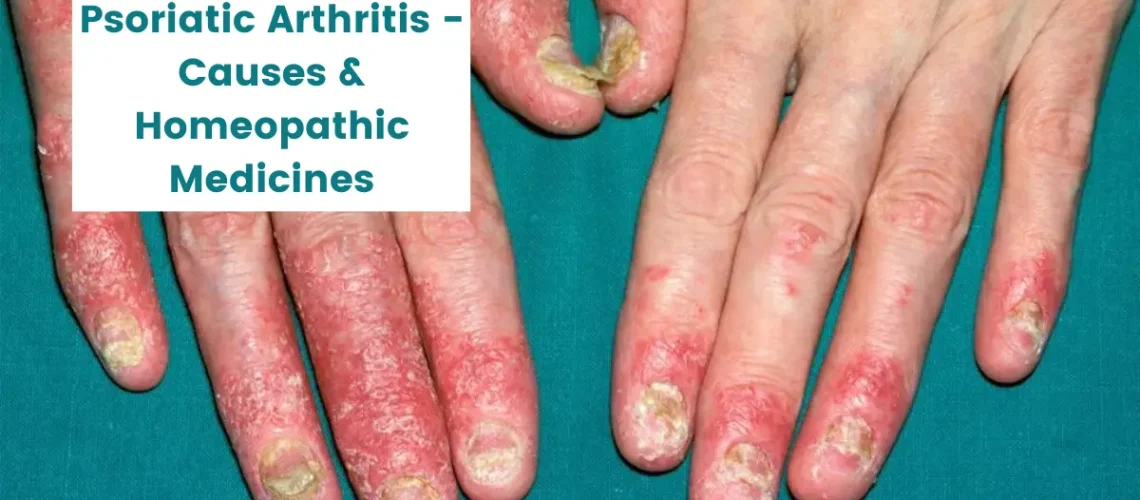 Psoriatic Arthritis - Causes and 11 Best Homeopathic Medicines