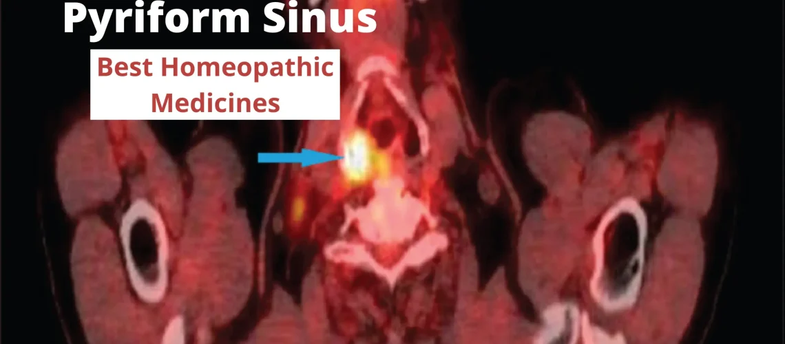 Pyriform Sinus - Causes, Symptoms and Best Homeopathic Medicines