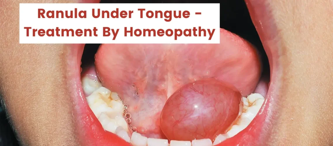 Ranula Under Tongue - Best Treatment By Homeopathy